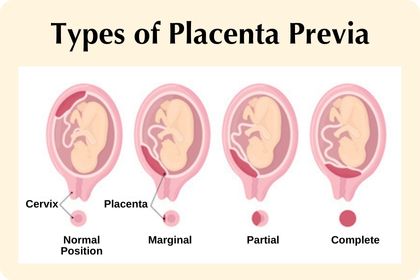 Placenta Previa: Types, Signs, and Risks